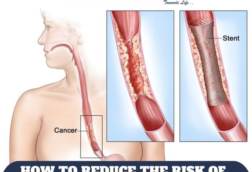 Esophageal Cancer Treatment inPune