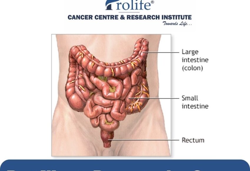 Best way to prevent colon cancer | Prolife Cancer Centre