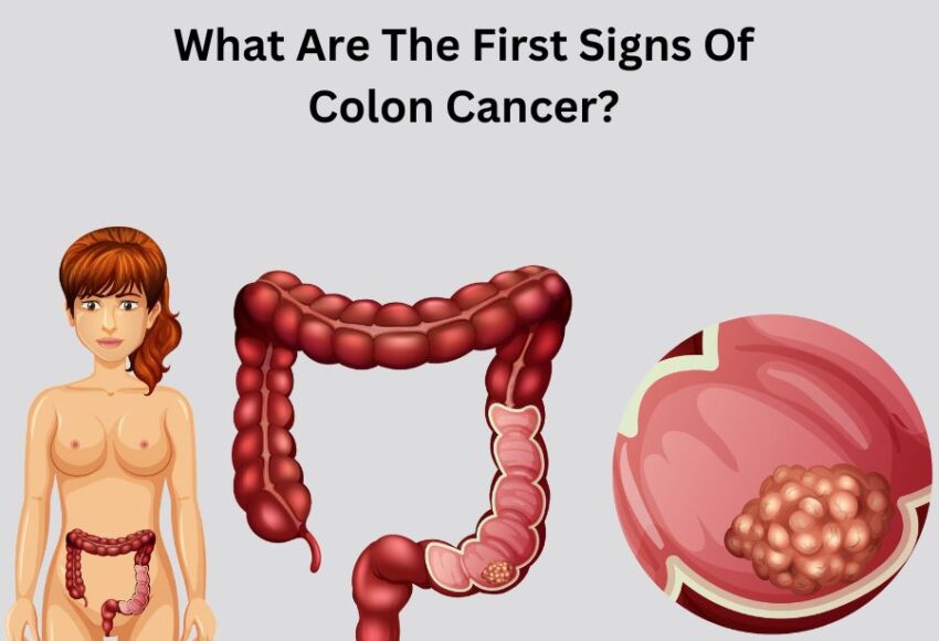 What Are The First Signs Of Colon Cancer? | Dr. Sumit Shah