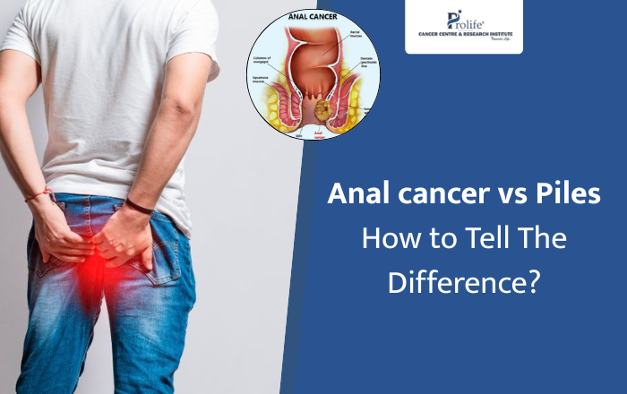 Anal Cancer vs Piles – How to Tell the Difference?