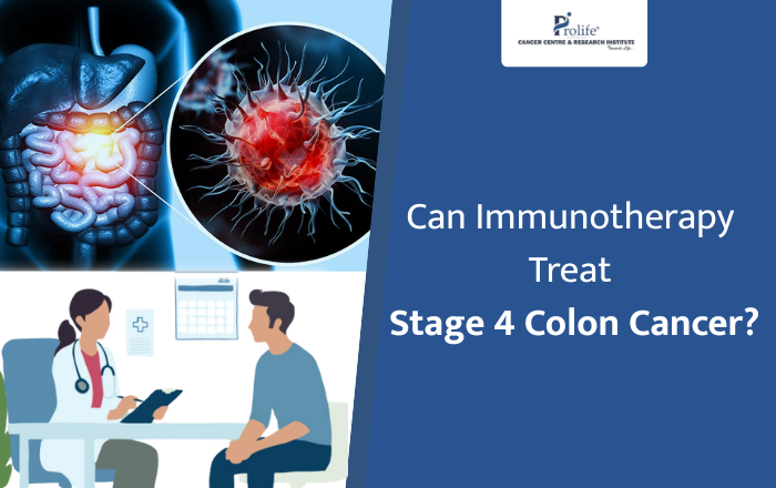 Can Immunotherapy Cure Stage 4 Colon Cancer?