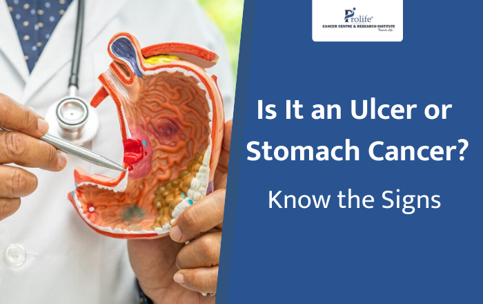 Is It an Ulcer or Stomach Cancer? How to Tell the Difference
